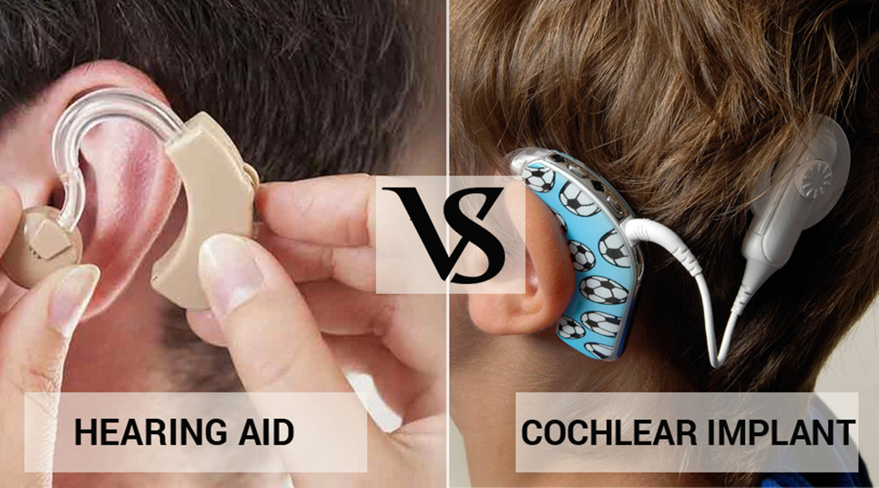 hearing aid vs cochlear implant