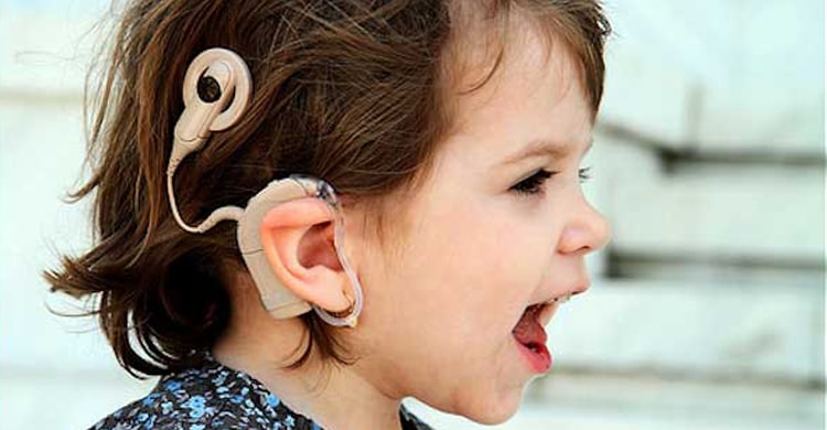Evaluation for Cochlear Implant